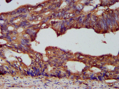 IHC image of CSB-PA017646LA01HU diluted at 1:200 and staining in paraffin-embedded human colon cancer performed on a Leica BondTM system. After dewaxing and hydration, antigen retrieval was mediated by high pressure in a citrate buffer (pH 6.0). S...