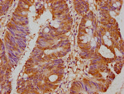 IHC image of CSB-PA017647LA01HU diluted at 1:500 and staining in paraffin-embedded human colon cancer performed on a Leica BondTM system. After dewaxing and hydration, antigen retrieval was mediated by high pressure in a citrate buffer (pH 6.0). S...