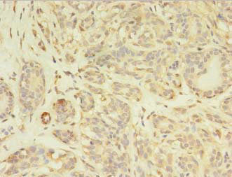 Immunohistochemistry of paraffin-embedded human breast cancer using CSB-PA017713LA01HU at dilution of 1:100