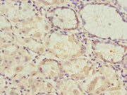 Immunohistochemistry of paraffin-embedded human gastric cancer using CSB-PA017717ESR2HU at dilution of 1:100