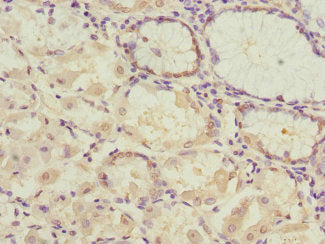 Immunohistochemistry of paraffin-embedded human gastric cancer using CSB-PA017717ESR2HU at dilution of 1:100