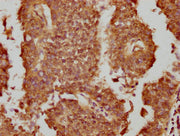 IHC image of CSB-PA017787LA01HU diluted at 1:300 and staining in paraffin-embedded human cervical cancer performed on a Leica BondTM system. After dewaxing and hydration, antigen retrieval was mediated by high pressure in a citrate buffer (pH 6.0)...