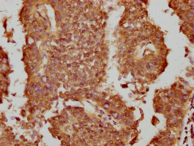 IHC image of CSB-PA017787LA01HU diluted at 1:300 and staining in paraffin-embedded human cervical cancer performed on a Leica BondTM system. After dewaxing and hydration, antigen retrieval was mediated by high pressure in a citrate buffer (pH 6.0)...