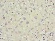 Immunohistochemistry of paraffin-embedded human liver cancer using CSB-PA017800ESR1HU at dilution of 1:100