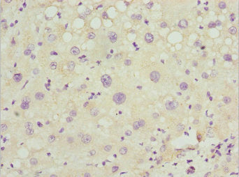 Immunohistochemistry of paraffin-embedded human liver cancer using CSB-PA017800ESR1HU at dilution of 1:100