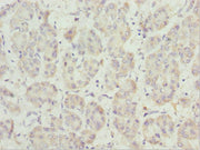 Immunohistochemistry of paraffin-embedded human liver cancer using CSB-PA017800ESR2HU at dilution of 1:100