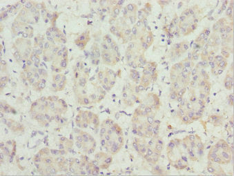 Immunohistochemistry of paraffin-embedded human liver cancer using CSB-PA017800ESR2HU at dilution of 1:100