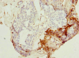 Immunohistochemistry of paraffin-embedded human breast cancer using CSB-PA017808ESR2HU at dilution of 1:100