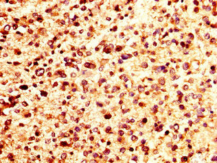 IHC image of CSB-PA017809LA01HU diluted at 1:200 and staining in paraffin-embedded human glioma performed on a Leica BondTM system. After dewaxing and hydration, antigen retrieval was mediated by high pressure in a citrate buffer (pH 6.0). Section...