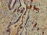 Immunohistochemistry of paraffin-embedded human prostate cancer using CSB-PA017811LA01HU at dilution of 1:100