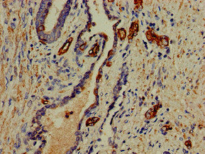 Immunohistochemistry of paraffin-embedded human prostate cancer using CSB-PA017811LA01HU at dilution of 1:100