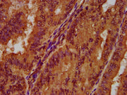 IHC image of CSB-PA017862LA01HU diluted at 1:300 and staining in paraffin-embedded human endometrial cancer performed on a Leica BondTM system. After dewaxing and hydration, antigen retrieval was mediated by high pressure in a citrate buffer (pH 6...