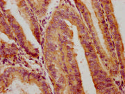 IHC image of CSB-PA017918LA01HU diluted at 1:300 and staining in paraffin-embedded human endometrial cancer performed on a Leica BondTM system. After dewaxing and hydration, antigen retrieval was mediated by high pressure in a citrate buffer (pH 6...