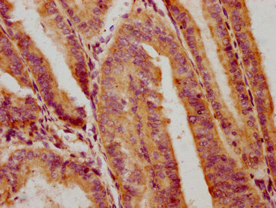 IHC image of CSB-PA017918LA01HU diluted at 1:300 and staining in paraffin-embedded human endometrial cancer performed on a Leica BondTM system. After dewaxing and hydration, antigen retrieval was mediated by high pressure in a citrate buffer (pH 6...