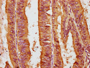 IHC image of CSB-PA017977LA01HU diluted at 1:200 and staining in paraffin-embedded human endometrial cancer performed on a Leica BondTM system. After dewaxing and hydration, antigen retrieval was mediated by high pressure in a citrate buffer (pH 6...