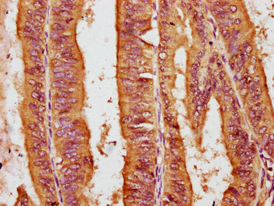 IHC image of CSB-PA017977LA01HU diluted at 1:200 and staining in paraffin-embedded human endometrial cancer performed on a Leica BondTM system. After dewaxing and hydration, antigen retrieval was mediated by high pressure in a citrate buffer (pH 6...