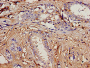 Immunohistochemistry analysis of human breast cancer using CSB-PA018020LA01HU at dilution of 1:100