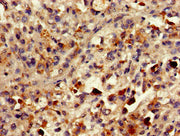 Immunohistochemistry of paraffin-embedded human melanoma using CSB-PA018085LA01HU at dilution of 1:100
