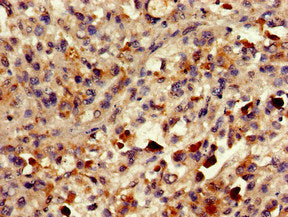 Immunohistochemistry of paraffin-embedded human melanoma using CSB-PA018085LA01HU at dilution of 1:100