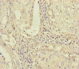 Immunohistochemistry of paraffin-embedded human lung cancer using CSB-PA018107ESR1HU at dilution of 1:100