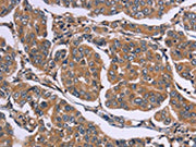 The image on the left is immunohistochemistry of paraffin-embedded Human breast cancer tissue using CSB-PA018113(EGR4 Antibody) at dilution 1/20, on the right is treated with synthetic peptide. (Original magnification: ×200)