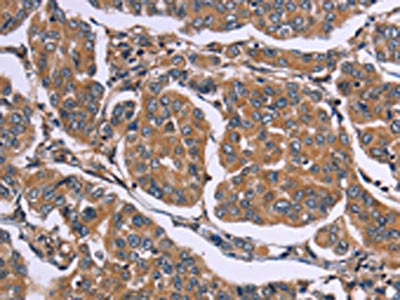 The image on the left is immunohistochemistry of paraffin-embedded Human breast cancer tissue using CSB-PA018113(EGR4 Antibody) at dilution 1/20, on the right is treated with synthetic peptide. (Original magnification: ×200)