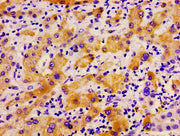 Immunohistochemistry of paraffin-embedded human liver cancer using CSB-PA018145LA01HU at dilution of 1:100
