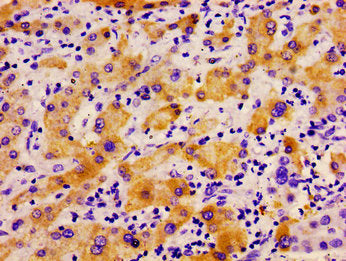 Immunohistochemistry of paraffin-embedded human liver cancer using CSB-PA018145LA01HU at dilution of 1:100