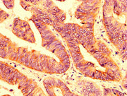 IHC image of CSB-PA018222LA01HU diluted at 1:200 and staining in paraffin-embedded human colon cancer performed on a Leica BondTM system. After dewaxing and hydration, antigen retrieval was mediated by high pressure in a citrate buffer (pH 6.0). S...