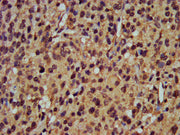 IHC image of CSB-PA018365LA01HU diluted at 1:400 and staining in paraffin-embedded human glioma performed on a Leica BondTM system. After dewaxing and hydration, antigen retrieval was mediated by high pressure in a citrate buffer (pH 6.0). Section...