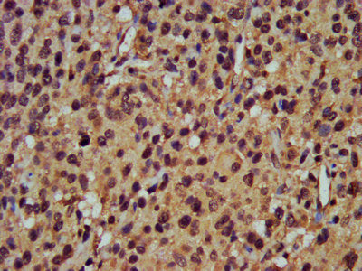 IHC image of CSB-PA018365LA01HU diluted at 1:400 and staining in paraffin-embedded human glioma performed on a Leica BondTM system. After dewaxing and hydration, antigen retrieval was mediated by high pressure in a citrate buffer (pH 6.0). Section...