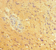Immunohistochemistry of paraffin-embedded human glioma using CSB-PA018397HA01HU at dilution of 1:100