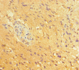 Immunohistochemistry of paraffin-embedded human glioma using CSB-PA018397HA01HU at dilution of 1:100