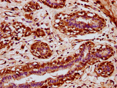 IHC image of CSB-PA018399LA01HU diluted at 1:200 and staining in paraffin-embedded human breast cancer performed on a Leica BondTM system. After dewaxing and hydration, antigen retrieval was mediated by high pressure in a citrate buffer (pH 6.0)....
