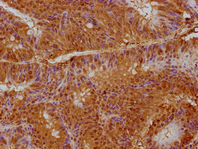 IHC image of CSB-PA018424LA01HU diluted at 1:200 and staining in paraffin-embedded human colon cancer performed on a Leica BondTM system. After dewaxing and hydration, antigen retrieval was mediated by high pressure in a citrate buffer (pH 6.0). S...