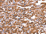 The image on the left is immunohistochemistry of paraffin-embedded Human thyroid cancer tissue using CSB-PA018431(FXR1 Antibody) at dilution 1/20, on the right is treated with synthetic peptide. (Original magnification: ×200)