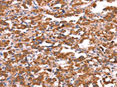 The image on the left is immunohistochemistry of paraffin-embedded Human thyroid cancer tissue using CSB-PA018431(FXR1 Antibody) at dilution 1/20, on the right is treated with synthetic peptide. (Original magnification: ×200)