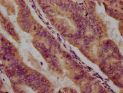 IHC image of CSB-PA018433LA01HU diluted at 1:500 and staining in paraffin-embedded human endometrial cancer performed on a Leica BondTM system. After dewaxing and hydration, antigen retrieval was mediated by high pressure in a citrate buffer (pH 6...