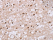 The image on the left is immunohistochemistry of paraffin-embedded Human brain tissue using CSB-PA018458(NUP50 Antibody) at dilution 1/30, on the right is treated with fusion protein. (Original magnification: ×200)