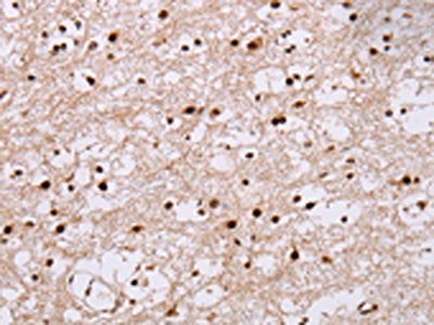The image on the left is immunohistochemistry of paraffin-embedded Human brain tissue using CSB-PA018458(NUP50 Antibody) at dilution 1/30, on the right is treated with fusion protein. (Original magnification: ×200)