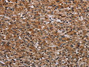 The image on the left is immunohistochemistry of paraffin-embedded Human prostate cancer tissue using CSB-PA018470(RPS6KB2 Antibody) at dilution 1/40, on the right is treated with synthetic peptide. (Original magnification: ×200)