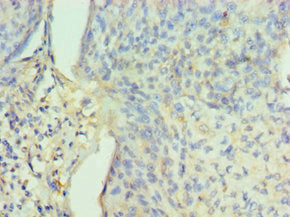 Immunohistochemistry of paraffin-embedded human cervical cancer using CSB-PA018474ESR2HU at dilution of 1:100