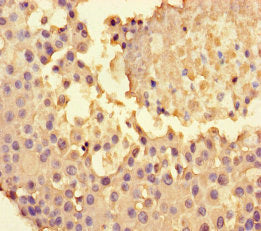 Immunohistochemistry of paraffin-embedded human breast cancer using CSB-PA018593LA01HU at dilution of 1:100