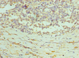 Immunohistochemistry of paraffin-embedded human colon cancer using CSB-PA018653ESR1HU at dilution of 1:100