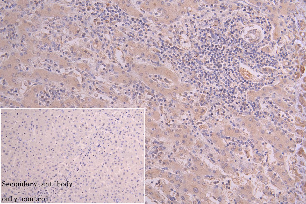 IHC image of CSB-PA018670LA01HU diluted at 1:66 and staining in paraffin-embedded human liver cancer performed on a Leica BondTM system. After dewaxing and hydration, antigen retrieval was mediated by high pressure in a citrate buffer (pH 6.0). Se...