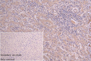 IHC image of CSB-PA018670LA01HU diluted at 1:66 and staining in paraffin-embedded human liver cancer performed on a Leica BondTM system. After dewaxing and hydration, antigen retrieval was mediated by high pressure in a citrate buffer (pH 6.0). Se...