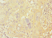 Immunohistochemistry of paraffin-embedded human liver cancer using CSB-PA018696ESR2HU at dilution of 1:100