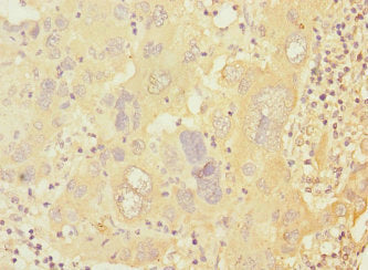 Immunohistochemistry of paraffin-embedded human liver cancer using CSB-PA018696ESR2HU at dilution of 1:100