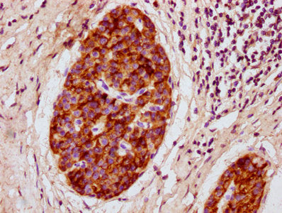 IHC image of CSB-PA018724LA01RA diluted at 1:300 and staining in paraffin-embedded human pancreatic cancer performed on a Leica BondTM system. After dewaxing and hydration, antigen retrieval was mediated by high pressure in a citrate buffer (pH 6....