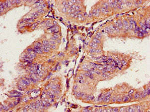 Immunohistochemistry of paraffin-embedded human endometrial cancer using CSB-PA018749YA01HU at dilution of 1:100